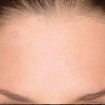 تصویر بعد از درمان