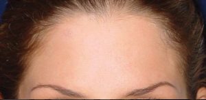 لیفت پیشانی - بعد از درمان