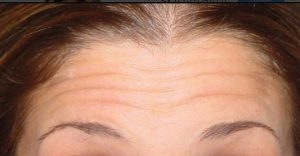 لیفت پیشانی - قبل از درمان