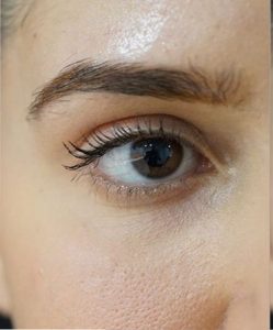 لیفت ابرو - قبل از درمان