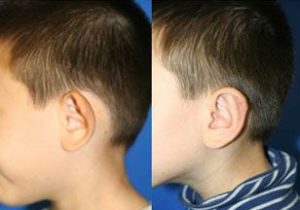 اتوپلاستی - قبل از درمان