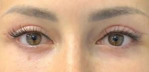 بلفاروپلاستی - بعد از درمان