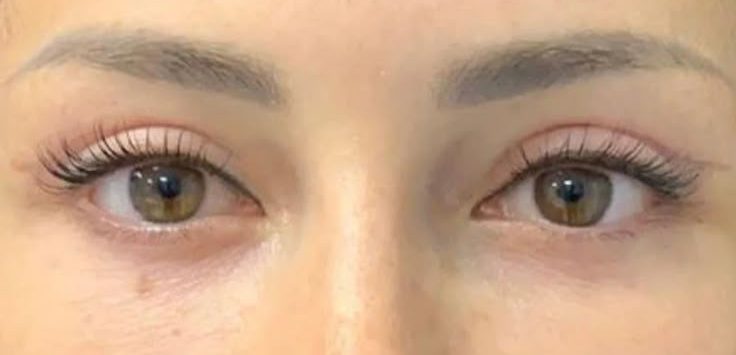 تصویر بعد از درمان