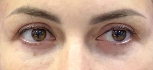 بلفاروپلاستی - قبل از درمان